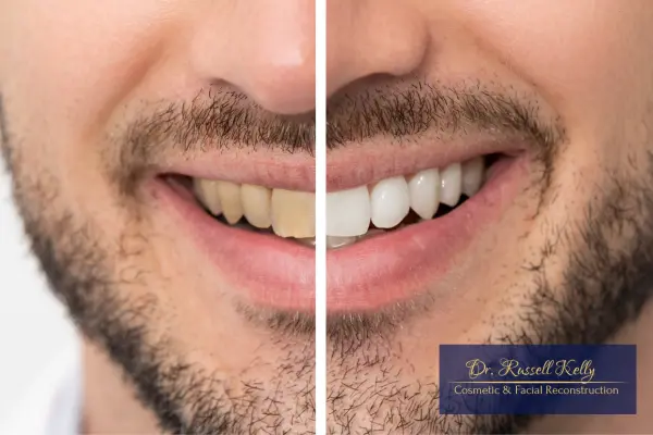 Composite Veneers_ Pros, Costs, and What to Expect