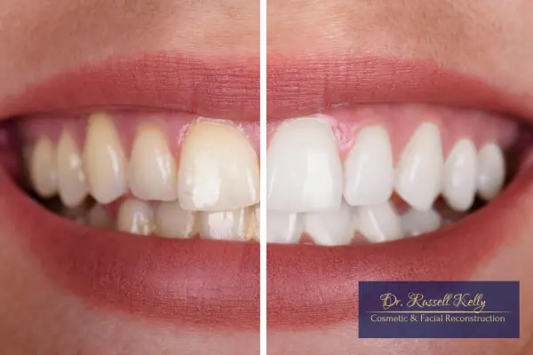 Invisalign® Clear Aligners_ Straight Teeth Without Braces