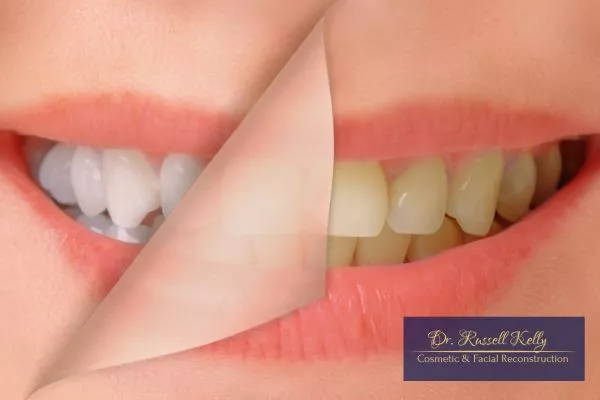 Smile Makeovers_ What They Really Cost—and Why Theyre Worth It Dr. Russell Kelly DDS